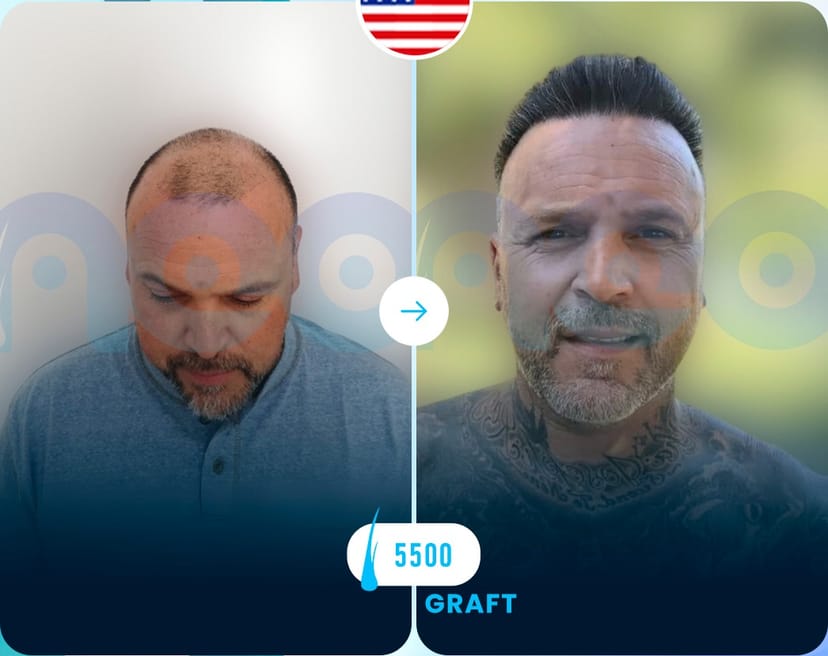 Neo Hair Before After 0