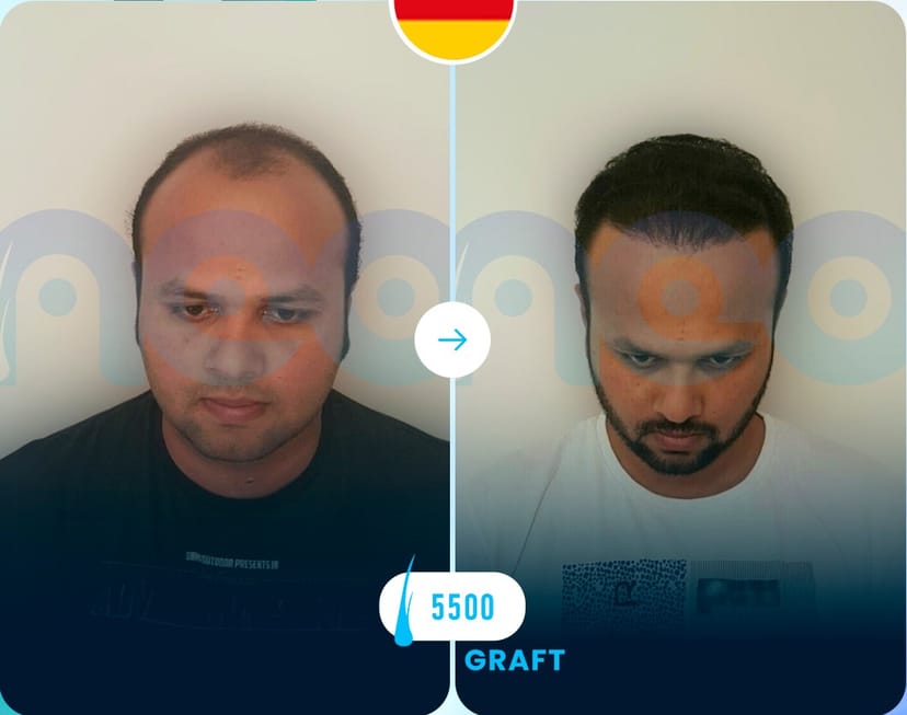 Neo Hair Before After 2