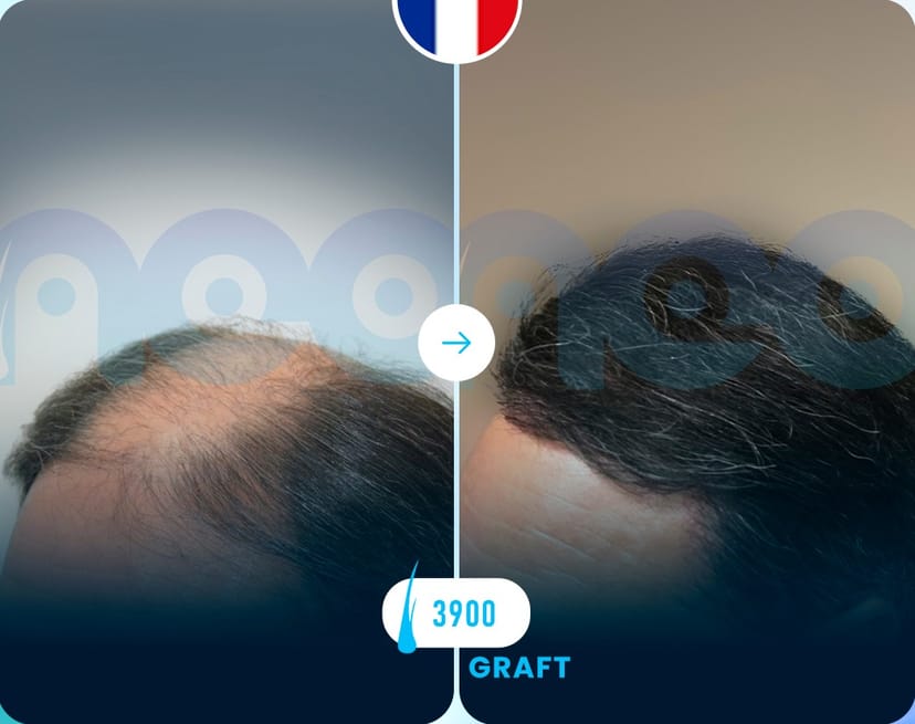 Neo Hair Before After 3