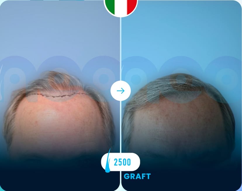 Neo Hair Before After 4